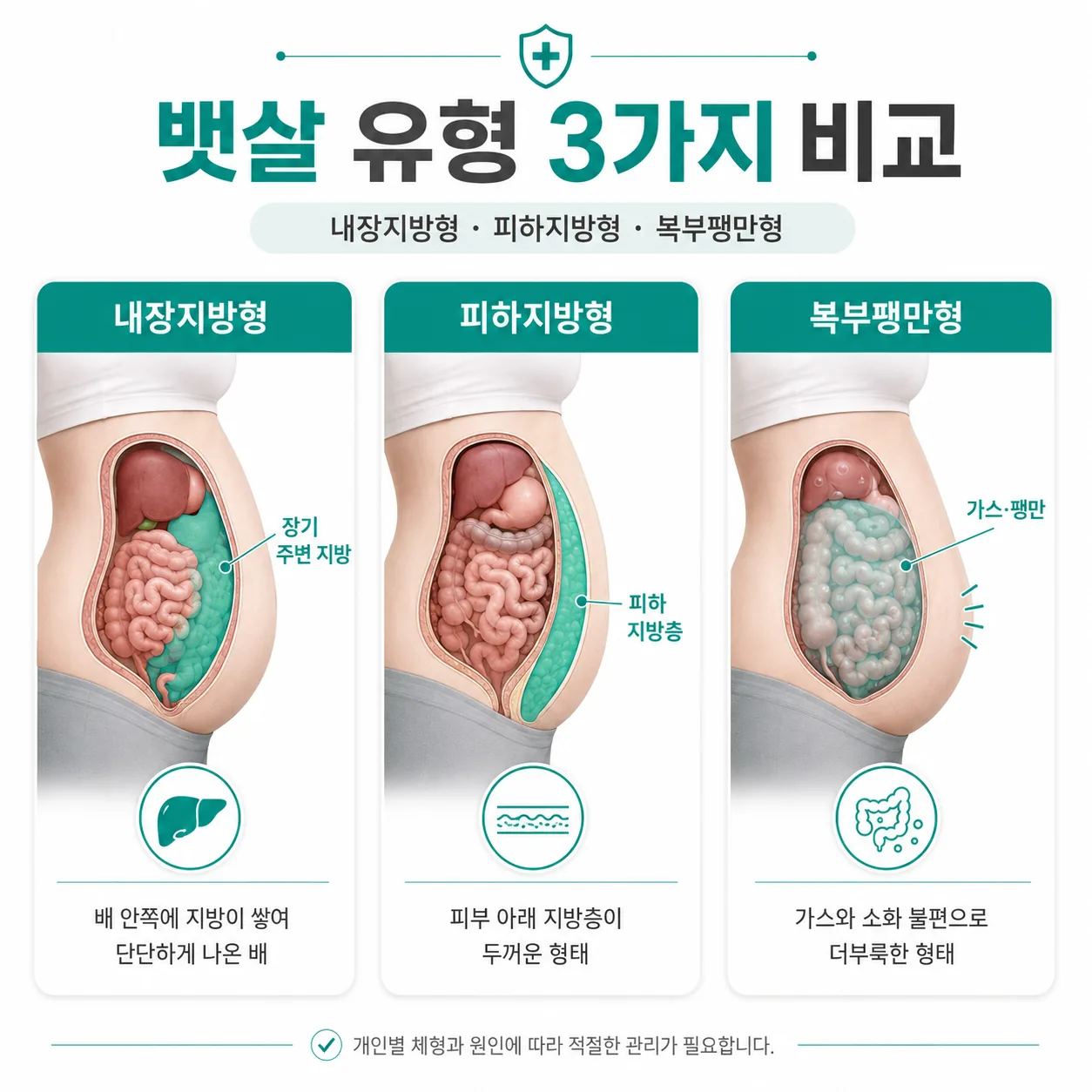 복부 비만 뱃살 유형 3가지 비교 일러스트