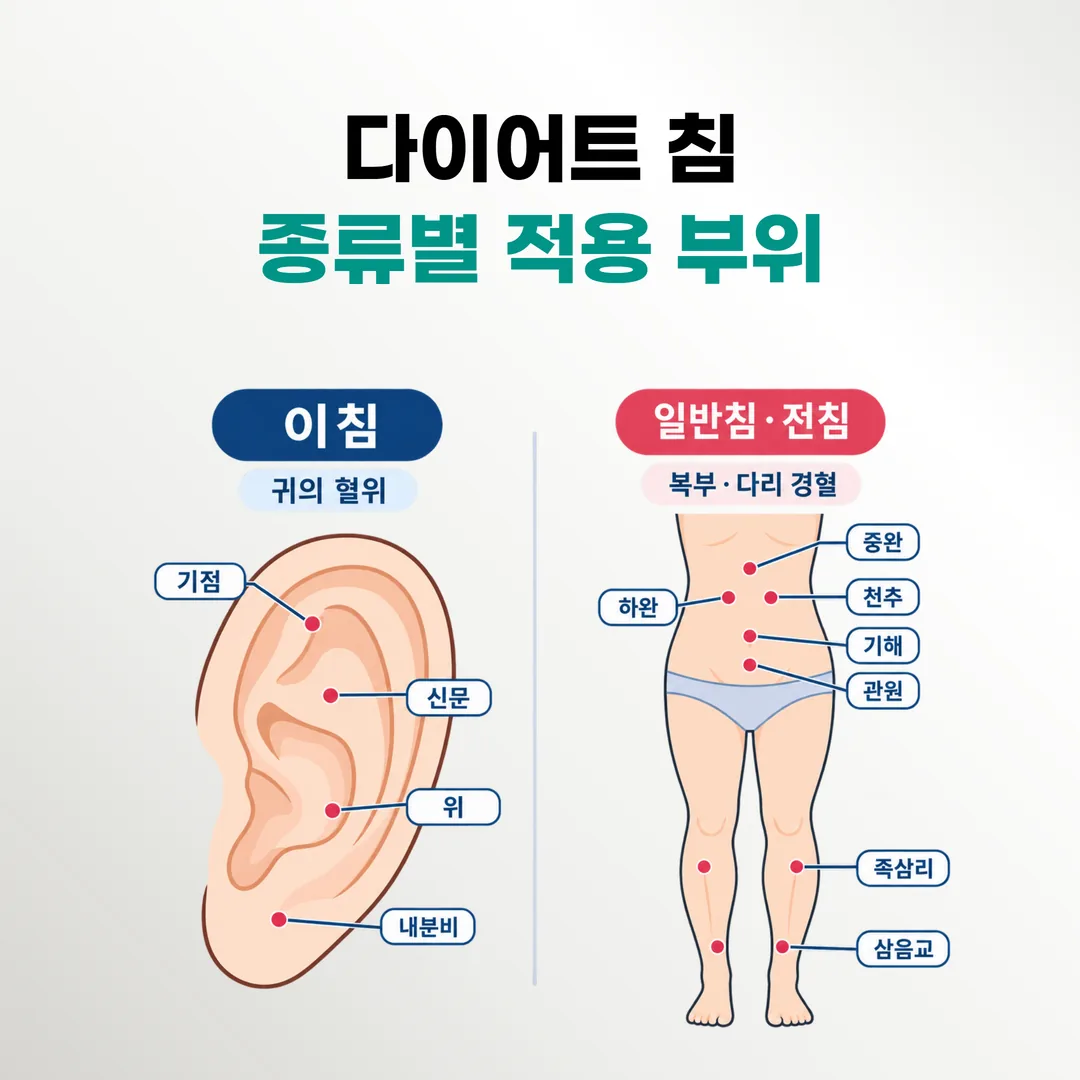 이침이 겨냥하는 귀의 혈위와 일반침·전침이 겨냥하는 복부·다리 경혈을 구분한 도식